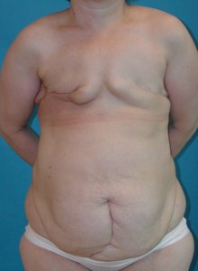 Patient before breast reconstruction using TRAM 